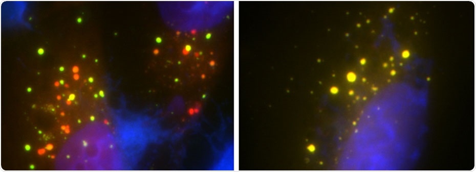 UMSOM researchers identify how certain gene mutations cause ALS