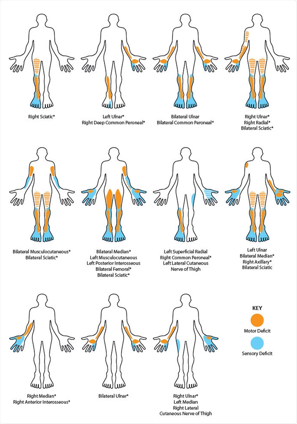 Schematic homuncular illustration of the sensory and motor deficits arising from the multiple mononeuropathies present in eleven patients recovering from severe COVID-19. * denote those neuropathies which were unequivocally confirmed electrophysiologically. Hatched shading indicates posterior muscle groups (hamstrings and triceps). In those neuropathies listed as sciatic there was involvement of both common peroneal and tibial divisions.