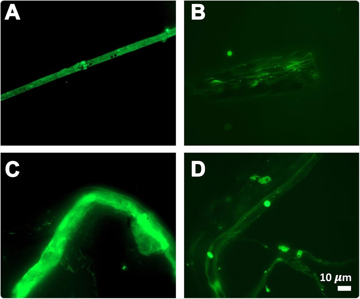 Fibrous or cellular deposits in the plasma smears of COVID-19 patients