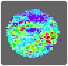 Alzheimer’s drug could be re-purposed to reverse blood vessel damage in diabetes