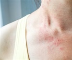 Skin rash may be a symptom of COVID-19