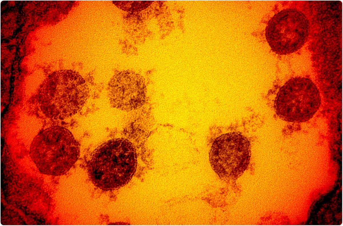 Novel Coronavirus SARS-CoV-2 Transmission electron micrograph of SARS-CoV-2 virus particles, isolated from a patient. Image captured and color-enhanced at the NIAID Integrated Research Facility (IRF) in Fort Detrick, Maryland. Credit: NIAID