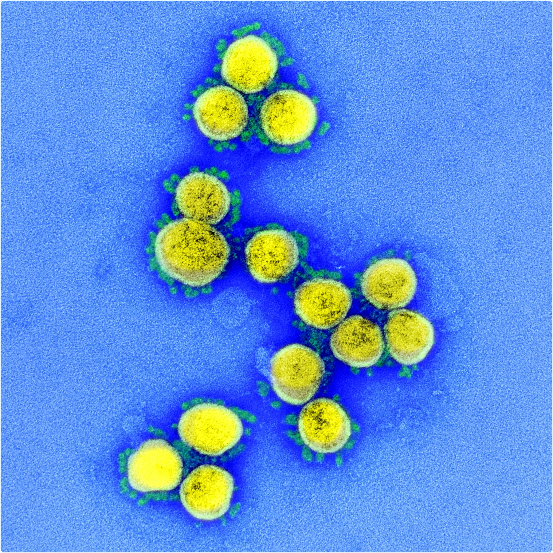 Novel Coronavirus SARS-CoV-2 Transmission electron micrograph of SARS-CoV-2 virus particles, isolated from a patient. Image captured and color-enhanced at the NIAID Integrated Research Facility (IRF) in Fort Detrick, Maryland. Credit: NIAID