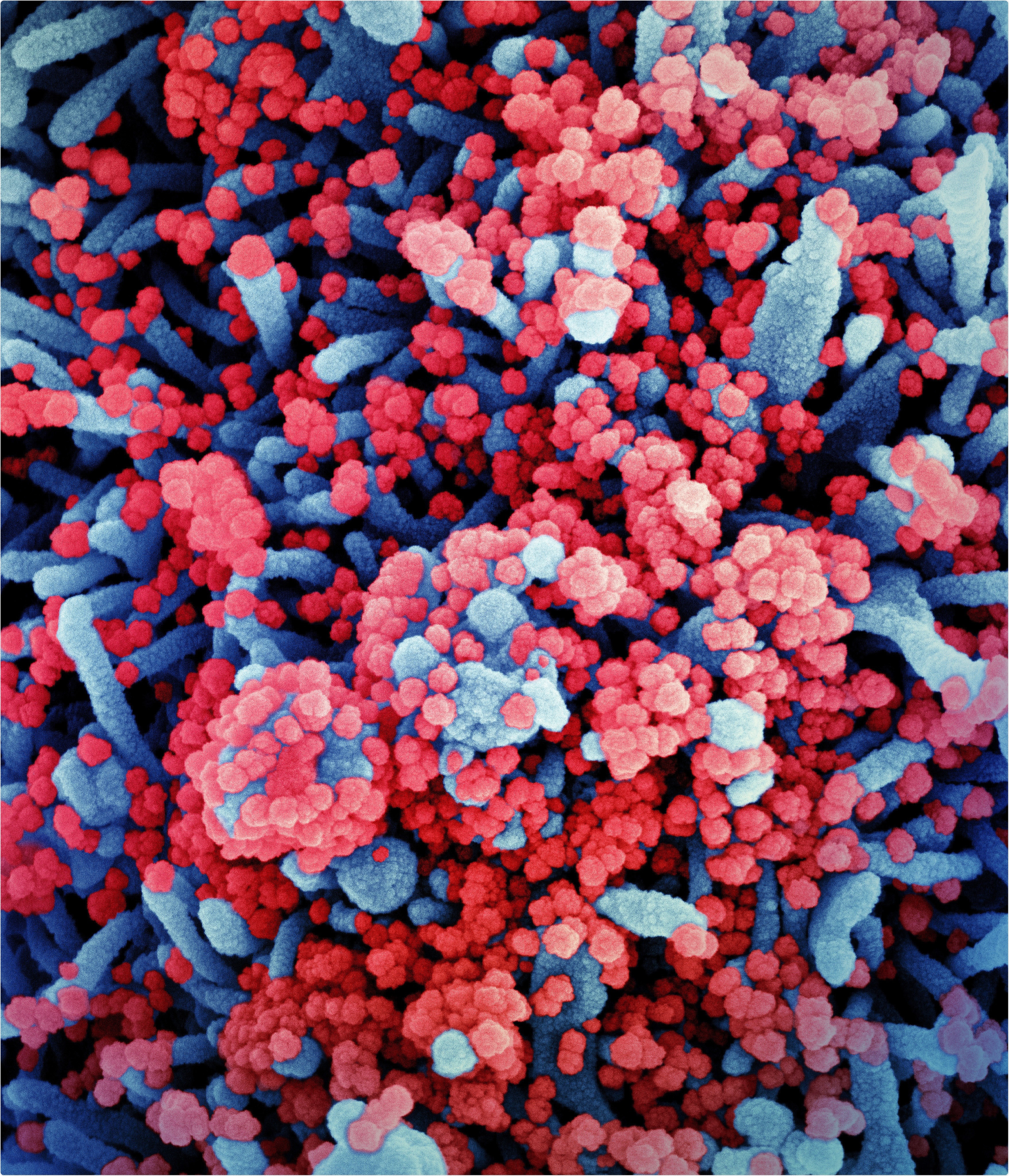 Colorized scanning electron micrograph of a cell (blue) heavily infected with SARS-CoV-2 virus particles (red), isolated from a patient sample. Image captured at the NIAID Integrated Research Facility (IRF) in Fort Detrick, Maryland. Credit: NIAID