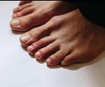 What are COVID Toes?