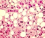 Study shows fatty liver disease is a significant risk factor for COVID-19 hospitalization
