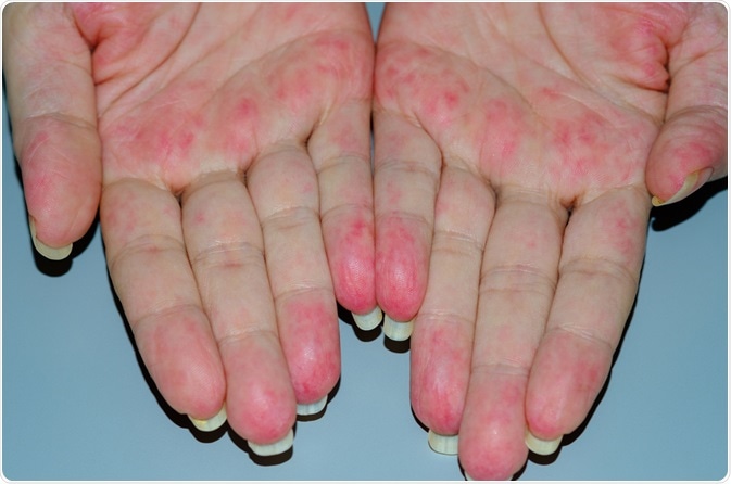 Vasculitis Vasculitis