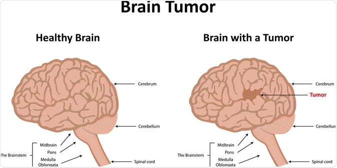 brain tumor