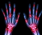 Immune molecule found to play a key role in regulating inflammation in rheumatoid arthritis