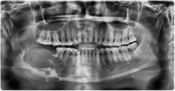 Ameloblastoma Ameloblastoma