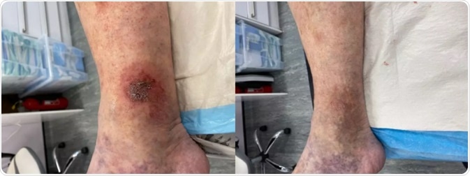 Causes and treatments of leg ulcers