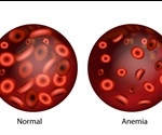 Fanconi Anemia Prognosis