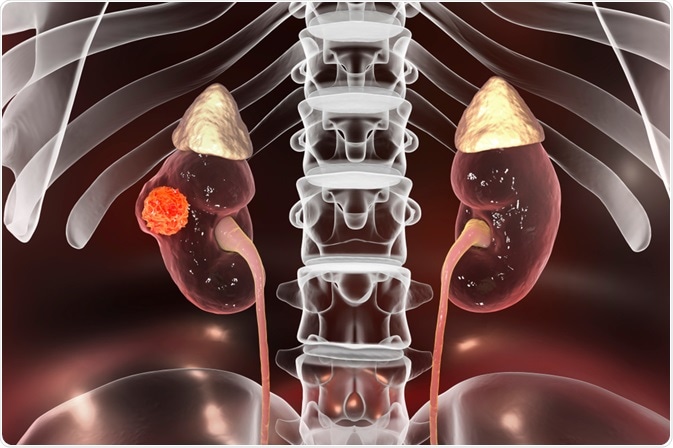 Kidney Cancer Kidney Cancer