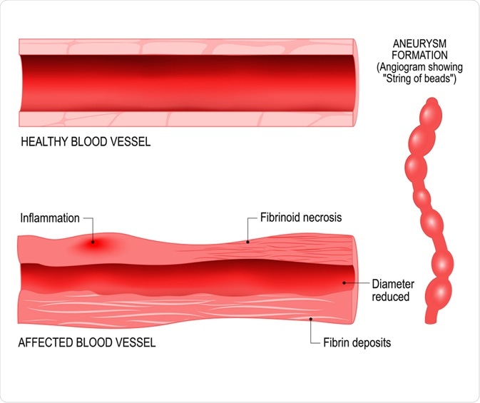 vasculitis
