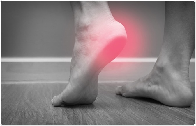 Plantar fasciitis