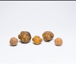 Symptoms and Diagnosis of Bladder Stones