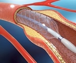 Drug-Eluting Stent Alternatives
