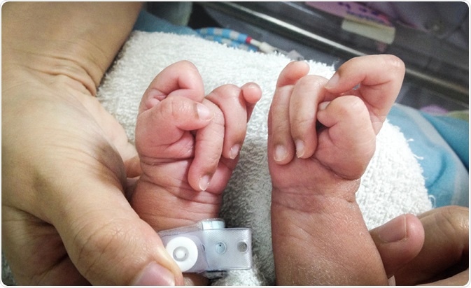 Clenched hand with overlapping fingers characteristically seen in Edwards syndrome. Image Credit: Chalie Chulapornsiri / Shutterstock Clenched hand with overlapping fingers characteristically seen in Edwards syndrome. Image Credit: Chalie Chulapornsiri / Shutterstock
