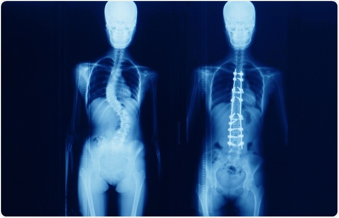 scoliosis