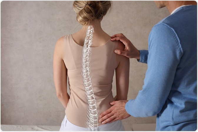 scoliosis