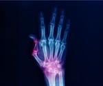 Rheumatology Treatments