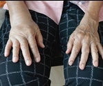 Chronic Edema Causes and Management