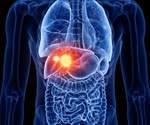 Radioemobilization for Liver Cancer