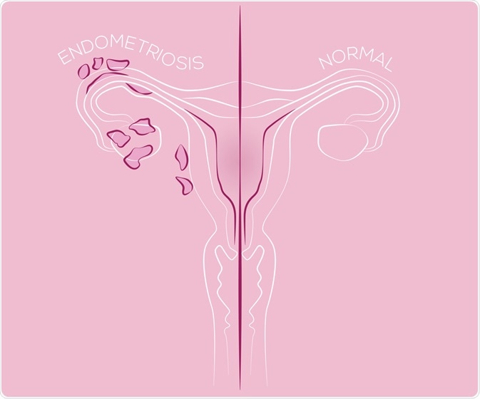 Endometriosis Endometriosis