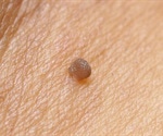 Seborrheic Keratosis Treatment Options