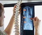 Scoliosis Prognosis