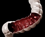 What are Colorectal Polyps?