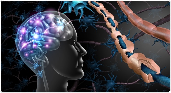 Multiple Sclerosis Concept Multiple Sclerosis Concept