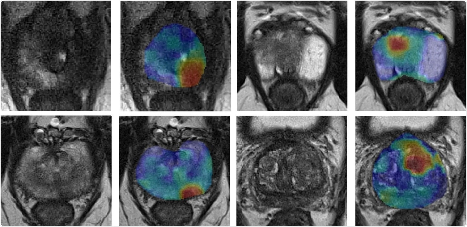 New form of MRI makes cancerous tissue to glow in medical images