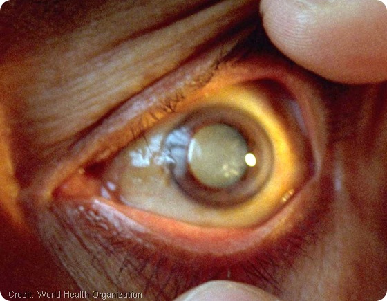 Cataract