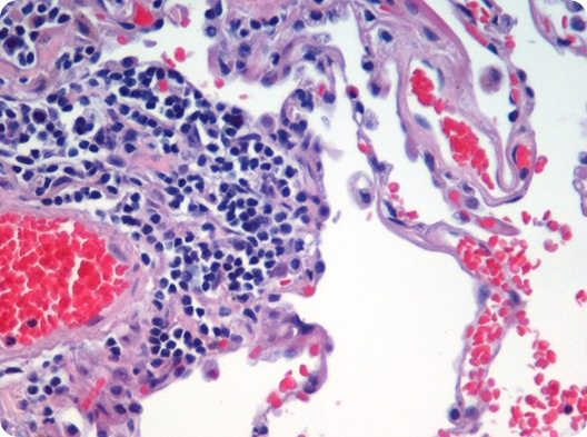 Image is of H&E (haematoxylin and eosin) stained lung tissue sample taken from an end-stage emphysema patient. Cell nuclei are blue-purple, red blood cells are red, other cell bodies and extracellular material are pink, and air spaces are white. Source: Image is of H&E (haematoxylin and eosin) stained lung tissue sample taken from an end-stage emphysema patient. Cell nuclei are blue-purple, red blood cells are red, other cell bodies and extracellular material are pink, and air spaces are white. Source: