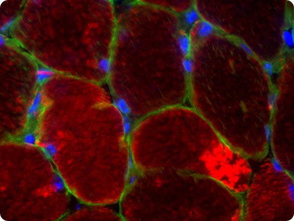 This is an image of a section taken from a muscle that has nemaline myopathy.  The bright, circled structures are the nemaline rods which are dense accumulations of proteins within the muscle cells.  The nemaline rods build up in the muscle cells and interfere with the contraction of the muscle. This is a fluorescently labeled image.