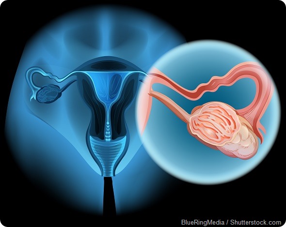Ovarian Cancer