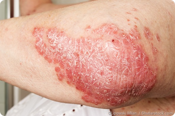 Psoriasis on elbow