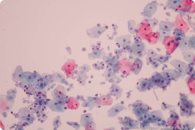Trichomonas vaginalis  pap smear test