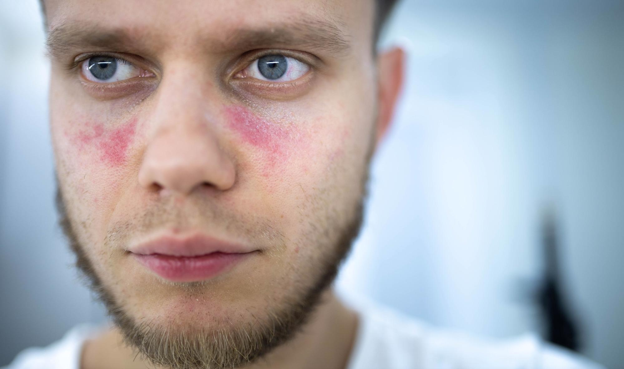 Age spots of redness on the face from systemic lupus erythematosus. Image Credit: Velimir Zeland / Shutterstock