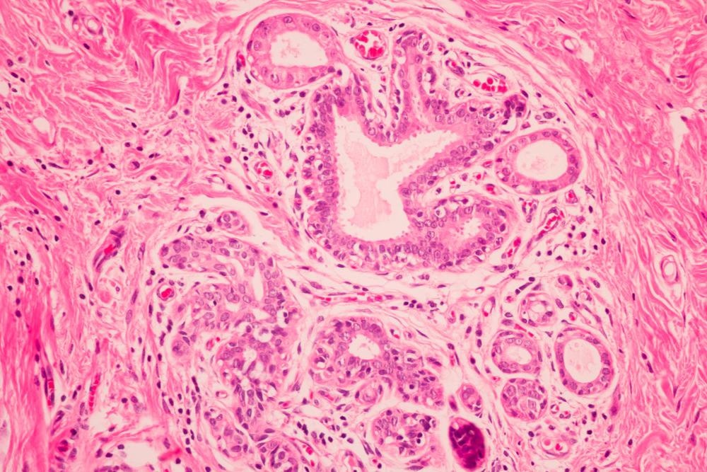 Breast cancer diagnosis