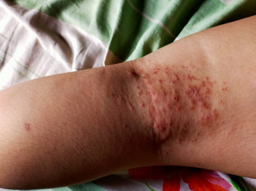 Bacterial Skin Infection