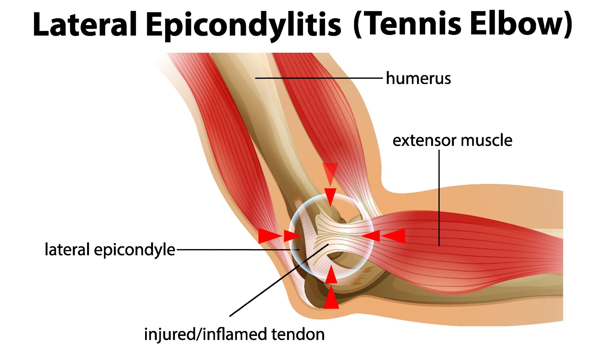 Lateral epicondylitis / tennis elbow illustration. Image Credit: BlueRingMedia / Shutterstock