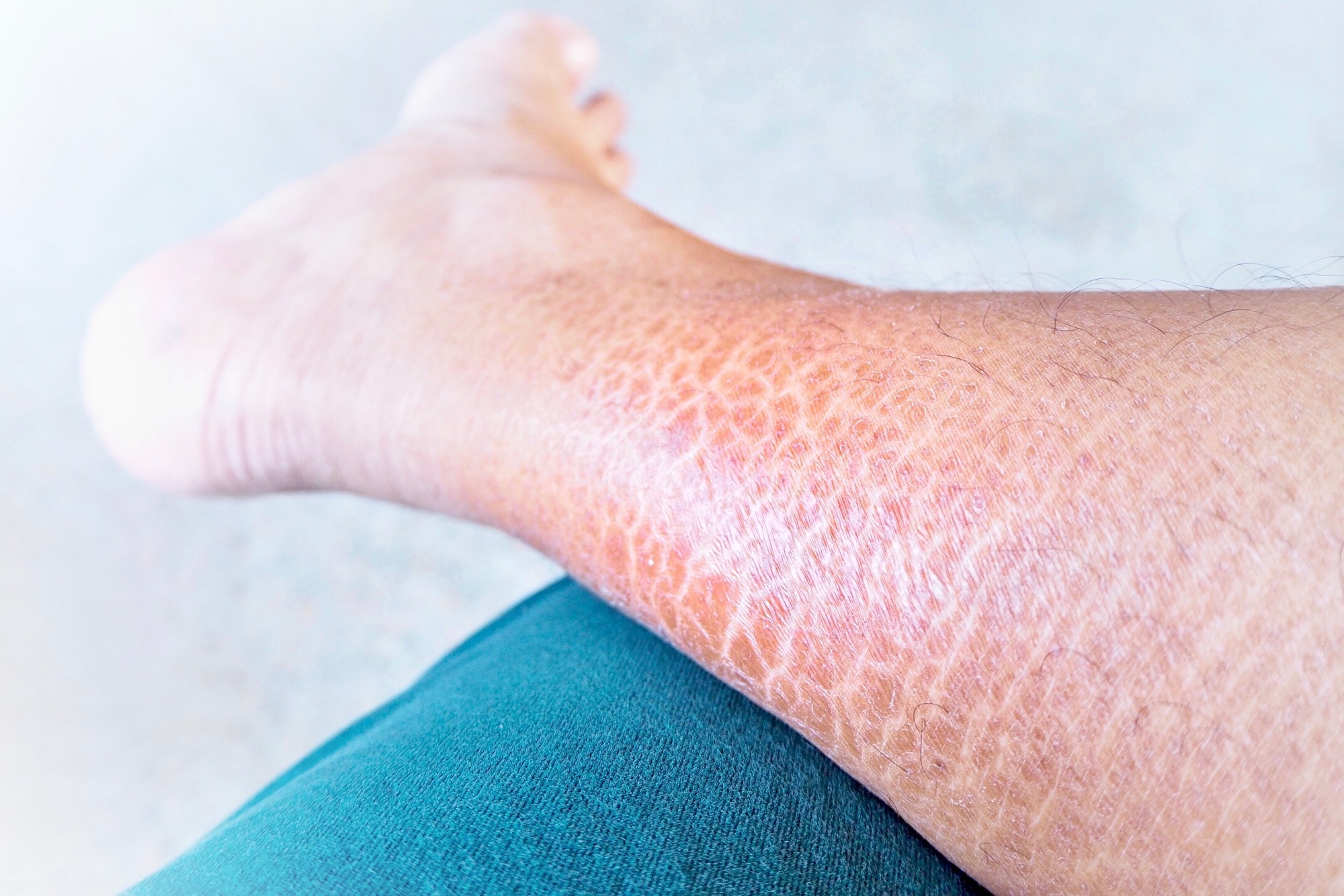 Ichthyosis vulgaris