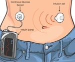 Navigating Insulin Pumps: Technology, Benefits, and What’s Next