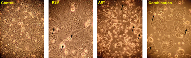 Changes in cell morphology following treatment with ART 7.8 μM, RSV 34.4 μM, and both drugs in combination compared with the effects of no treatment. All treatments exhibit an antiproliferative effect on Ishikawa EC cells. The combination treatment appears to inhibit proliferation the most effectively after treatment for 72 hours.