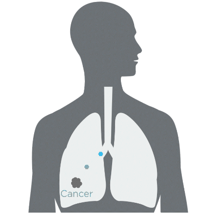 What disease areas can benefit from breath analysis?