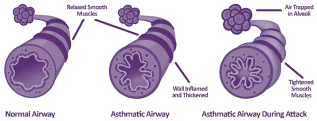 Asthma management in winter using FeNO testing