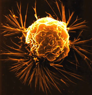 A breast cancer cell as seen through an electron microscope