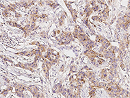 Recombinant IL-13 receptors for inflammatory diseases and cancer